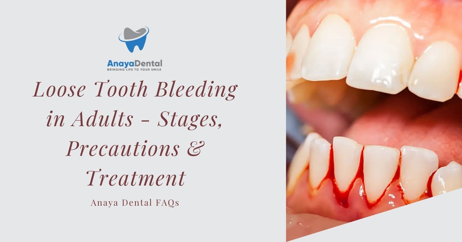 Loose Tooth Bleeding in Adults