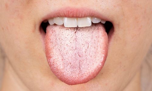 Oral Thrush (Candidiasis)