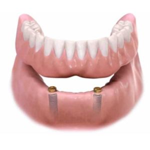 Overdenture