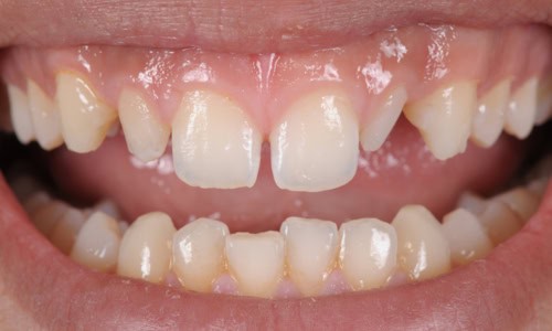 how to fix a Peg Lateral Teeth