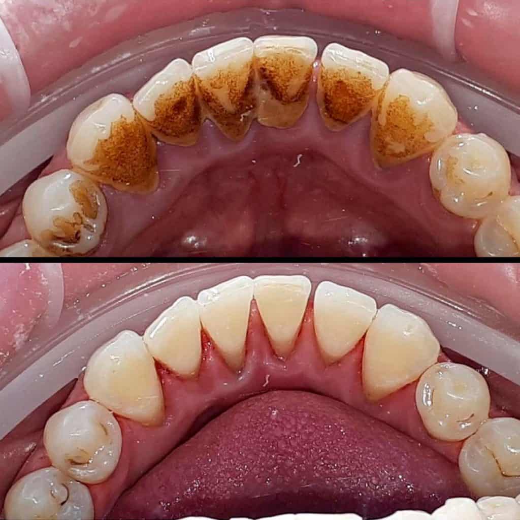 Tartar Breaking off from Tooth while Cleaning