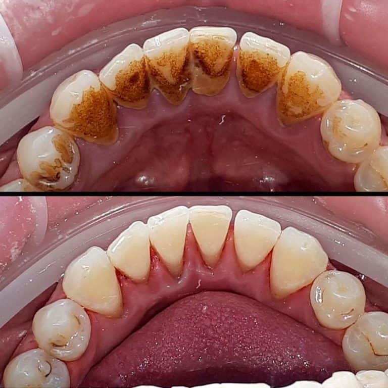 What Does Tartar Look Like When It Breaks Off