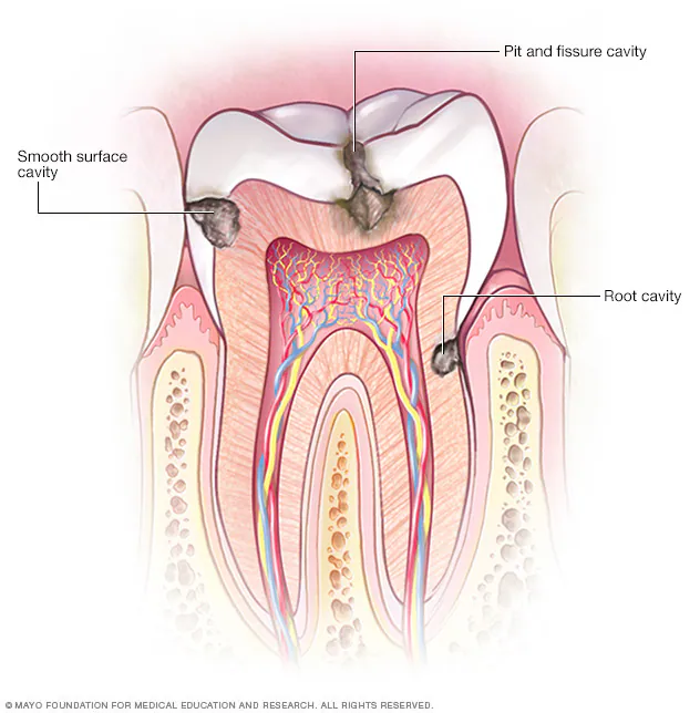 Tooth Cavities