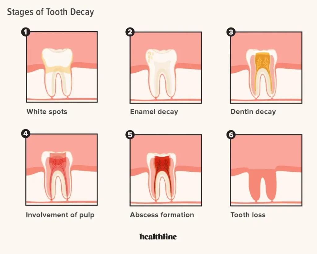 Tooth Enamel Erosion Stages