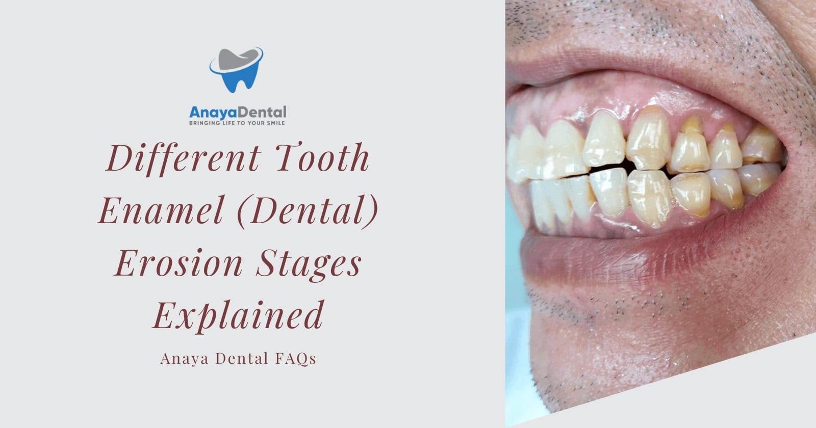 Tooth Enamel Erosion Stages