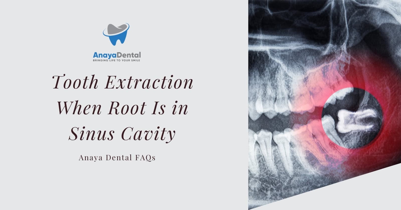 Tooth Extraction When Root Is in Sinus Cavity