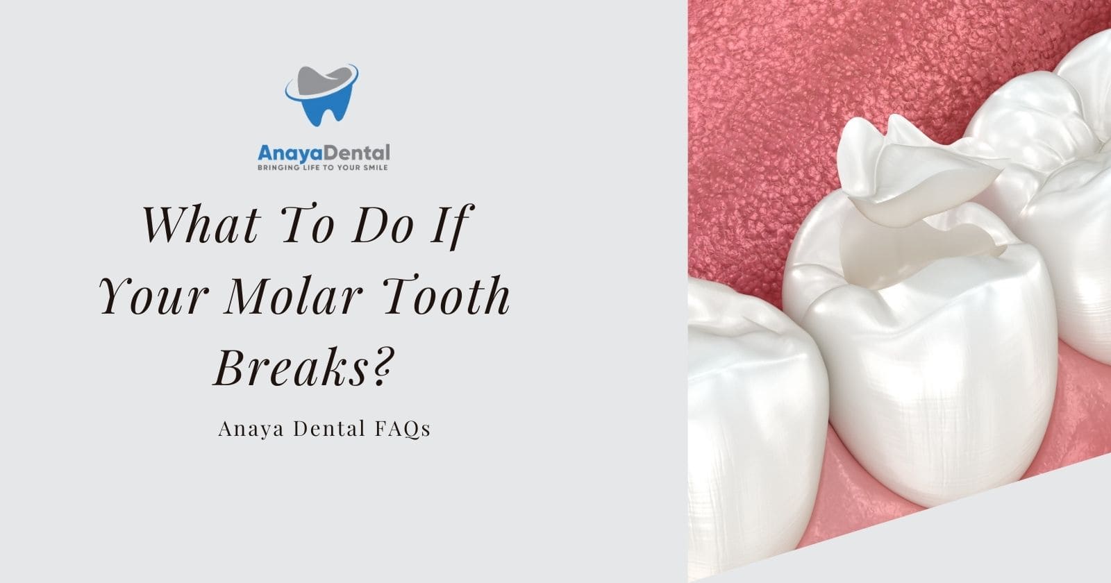 What To Do If Your Molar Tooth Breaks