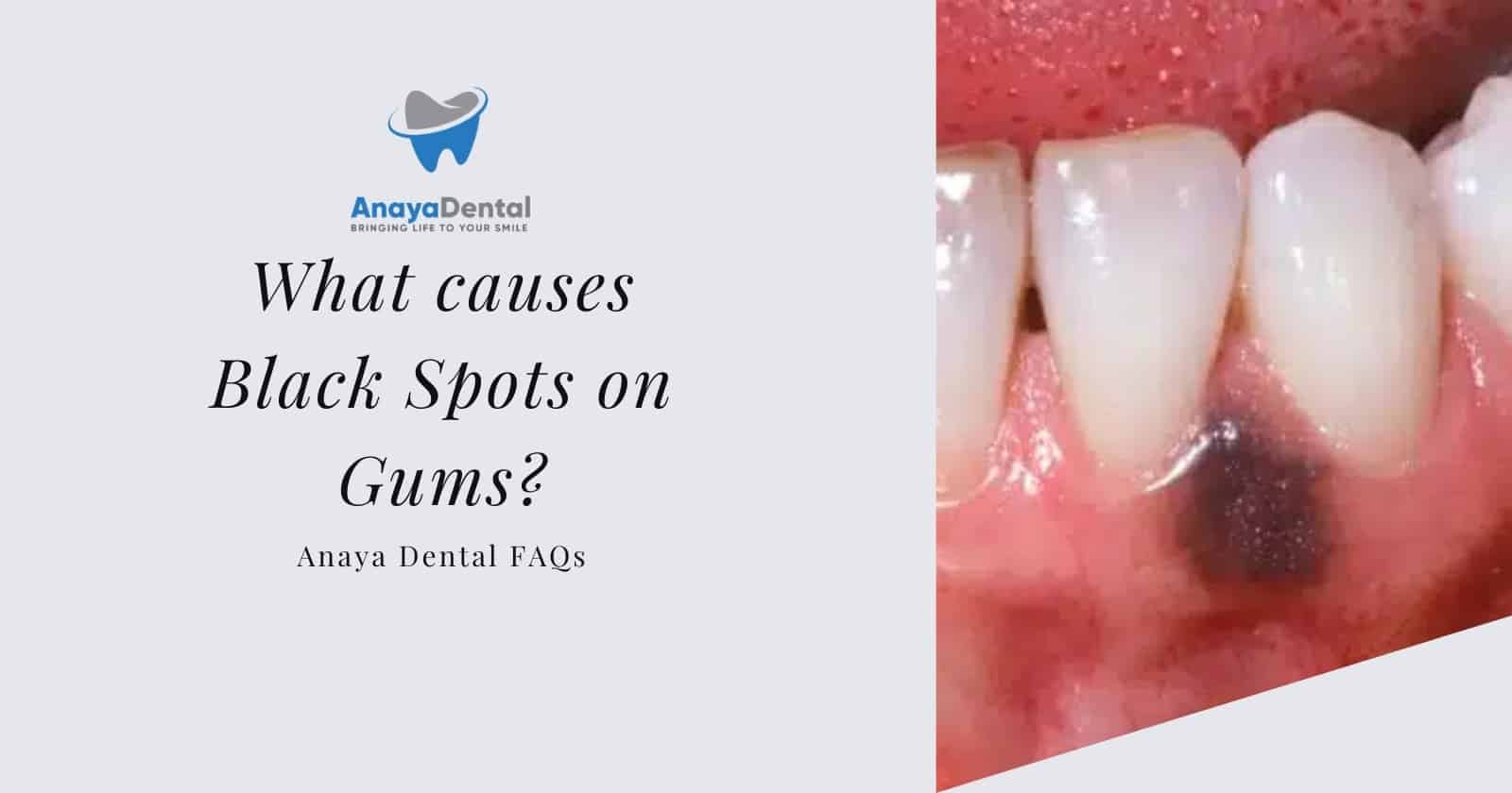 What causes Black Spots on Gums