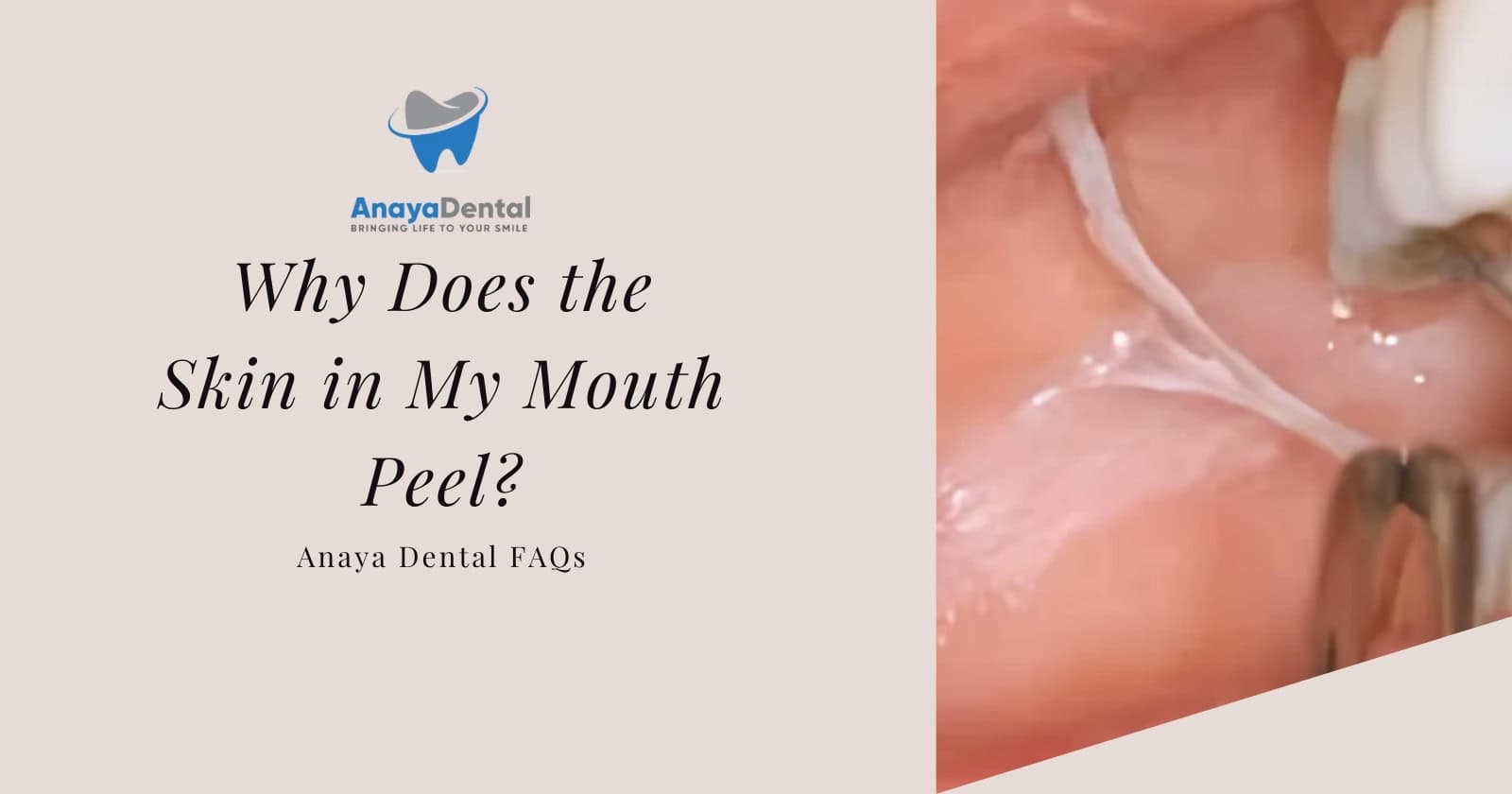 Why Does the Skin in My Mouth Peel