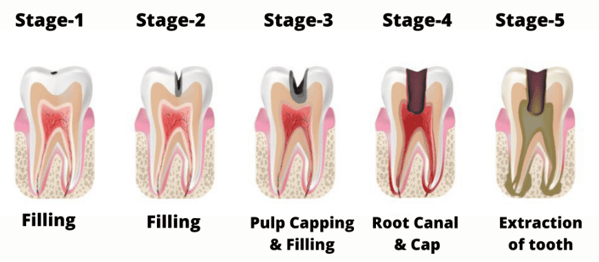 Stages of Tooth Mobility