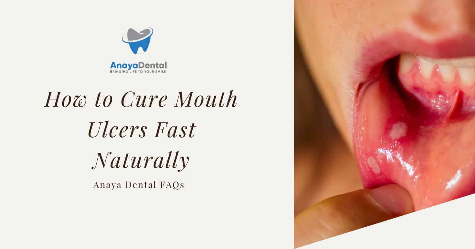 How to Cure Mouth Ulcers Fast Naturally