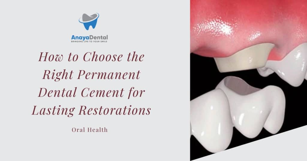 How to Choose the Right Permanent Dental Cement for Lasting