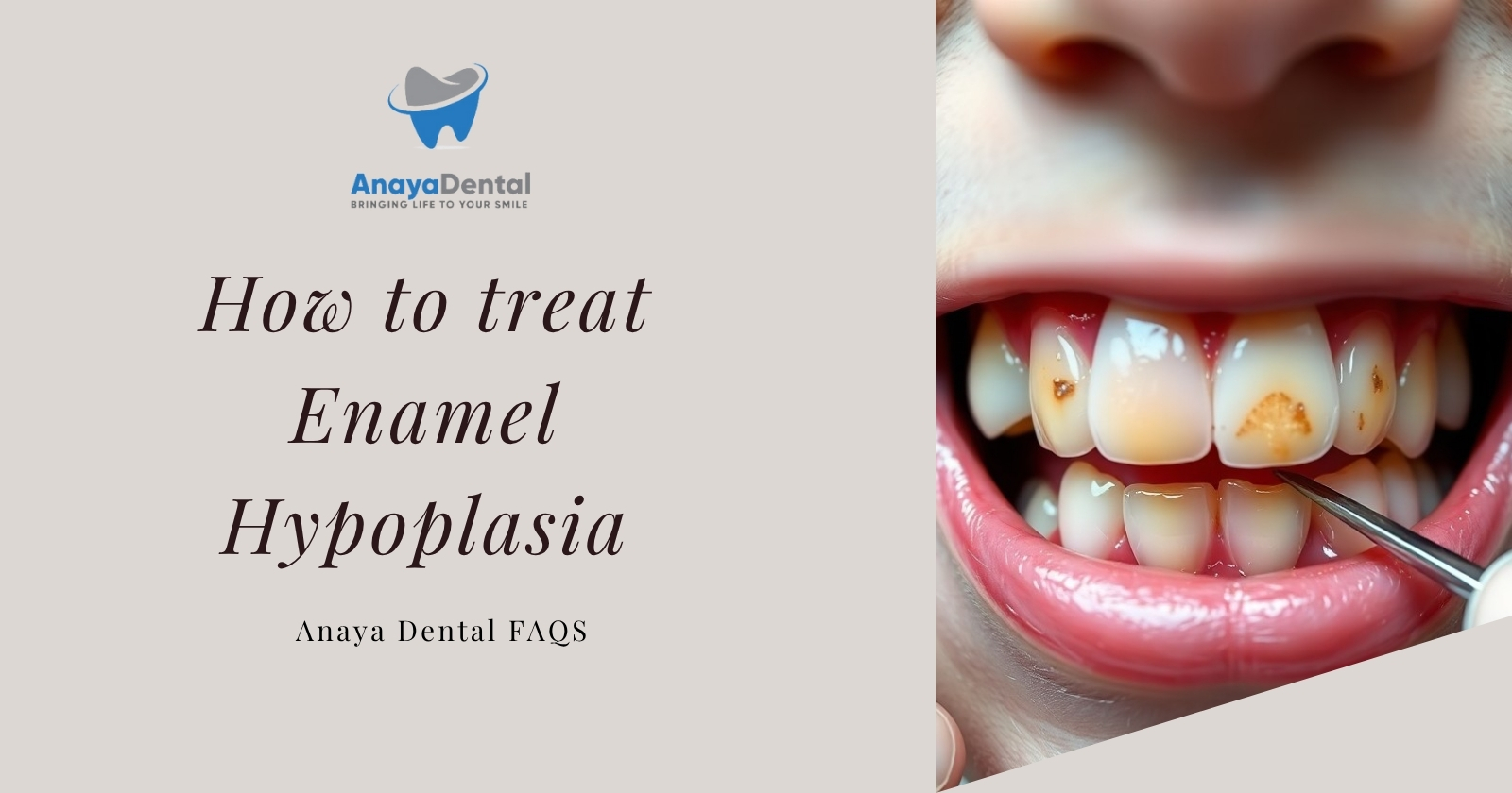how to treat enamel hypoplasia