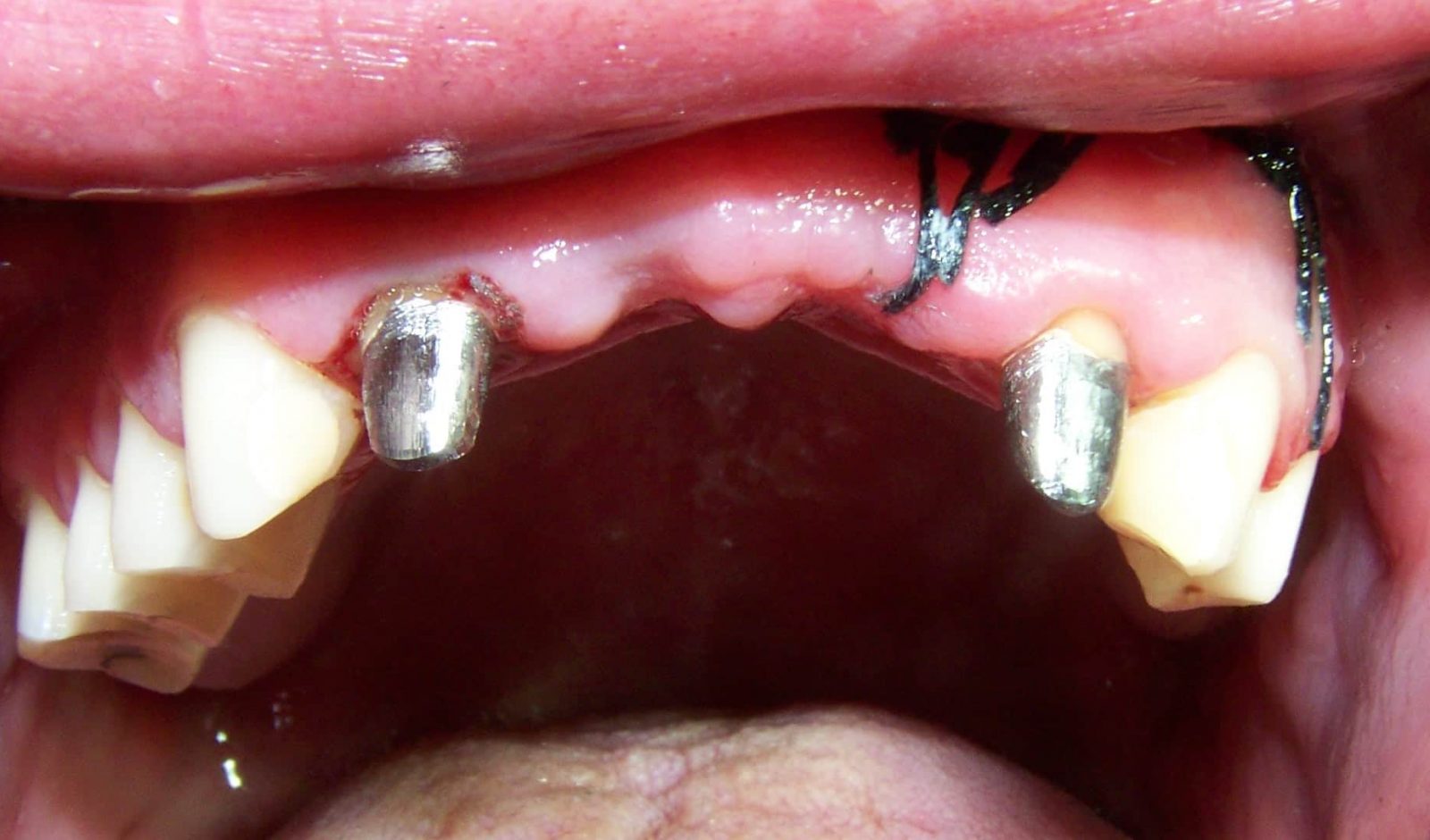 Replace Front Teeth with a Dental Bridge