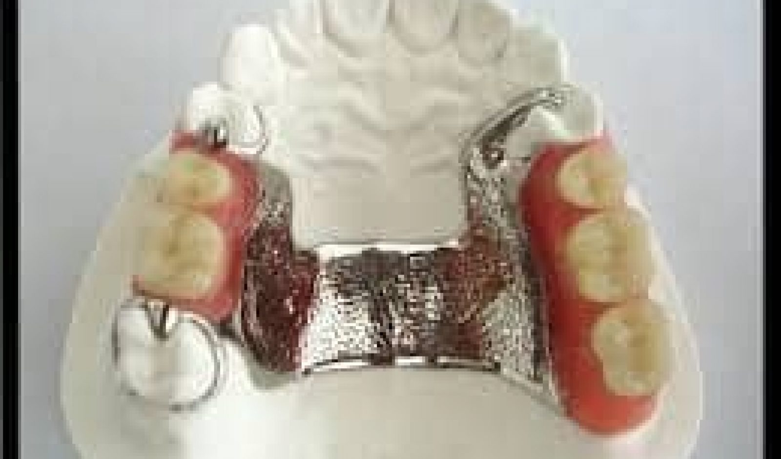 All you need to know about Cast Partial Denture